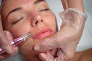 Cosmetician microneedling using skinMate at Chichester Active Beauty
