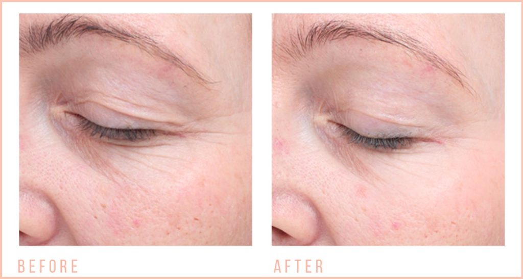Non-Surgical Facial, Wrinkle Reduction